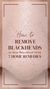 How to Remove Blackheads on Nose Naturally at Home: 7 Home Remedies