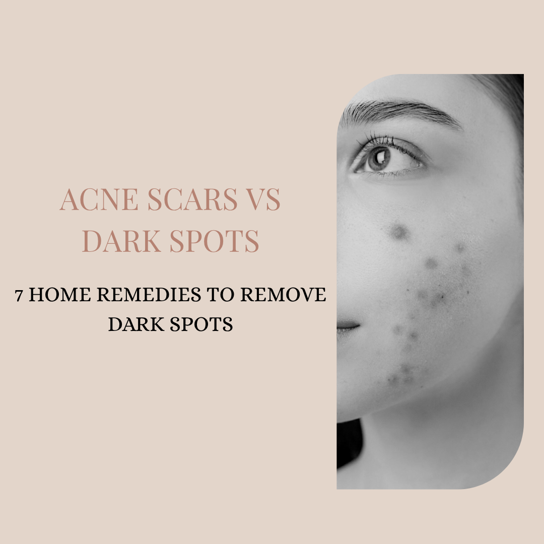 Acne Scars vs Dark Spots: 7 Home Remedies to Remove Dark Spots